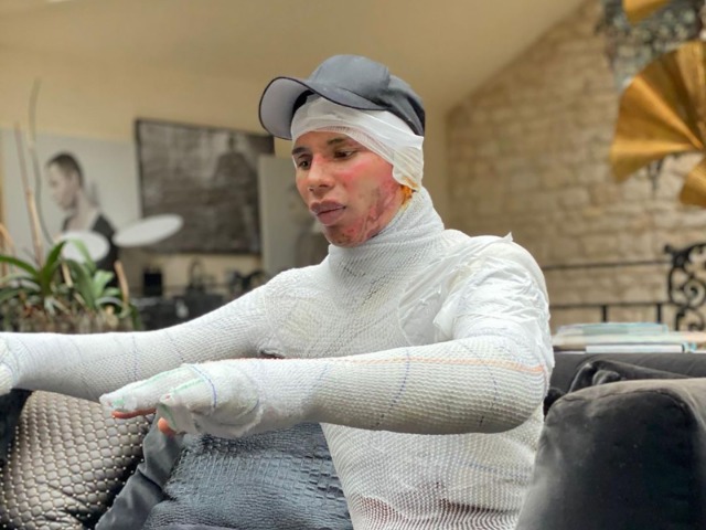 Шрамы и ожоги: Оливье Рустен пострадал во время взрыва в своем доме